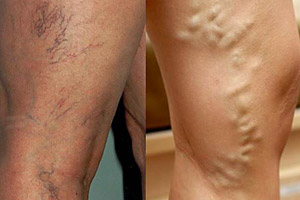 VEIN Clinic | Varicose veins Treatment | Laser treatment for varicose veins