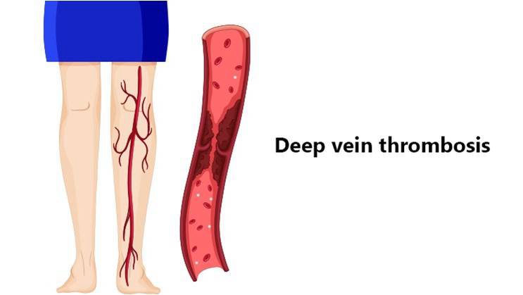 deep-vein-thrombosis dvt