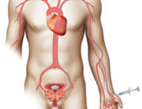 Prostatic Artery Embolization (PAE)